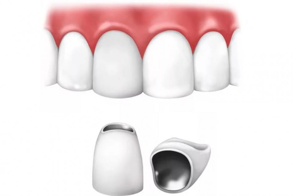 Сколько стоит коронка на зуб из металлокерамики?