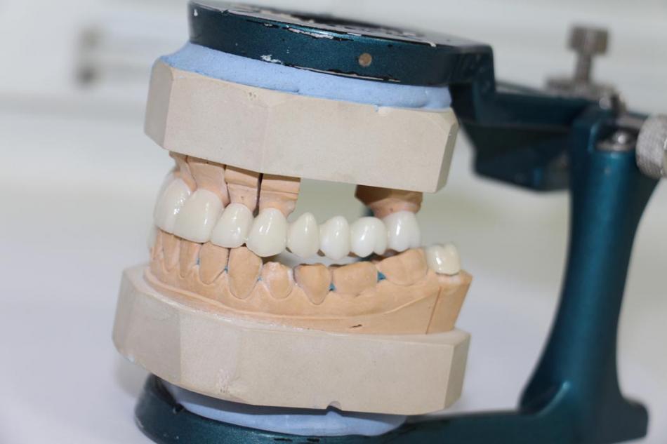 Показания к несъемному протезированию зубов.