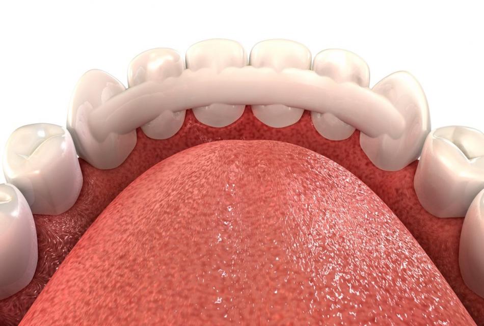 Шинирование подвижных зубов при заболевании пародонта.