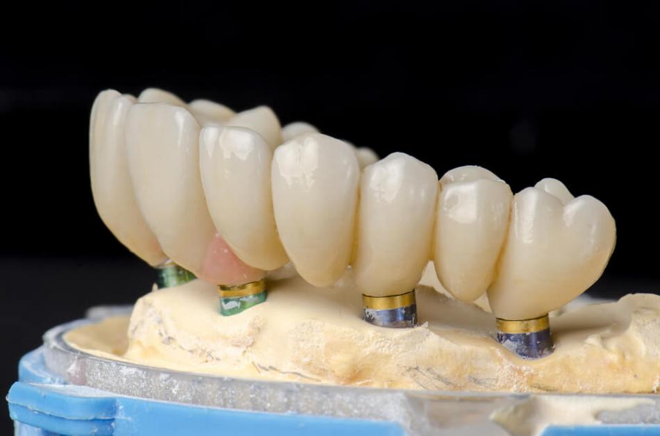 Стоимость зубного мостовидного протеза.
