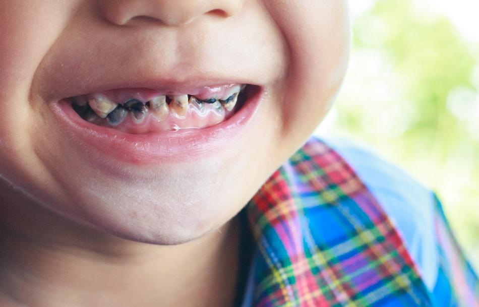 Стоимость серебрения молочных зубов у маленьких детей.