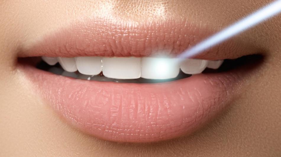 Лазерное отбеливание зубов - щадящая процедура.