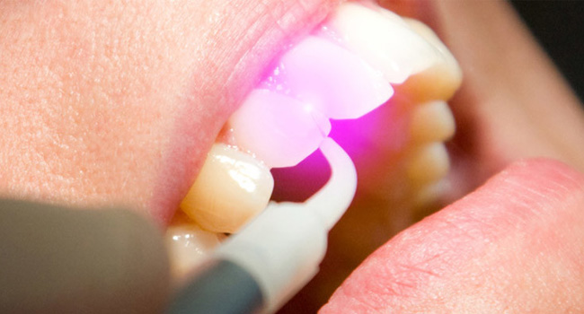 Особенности лазерного лечения кариеса зубов.