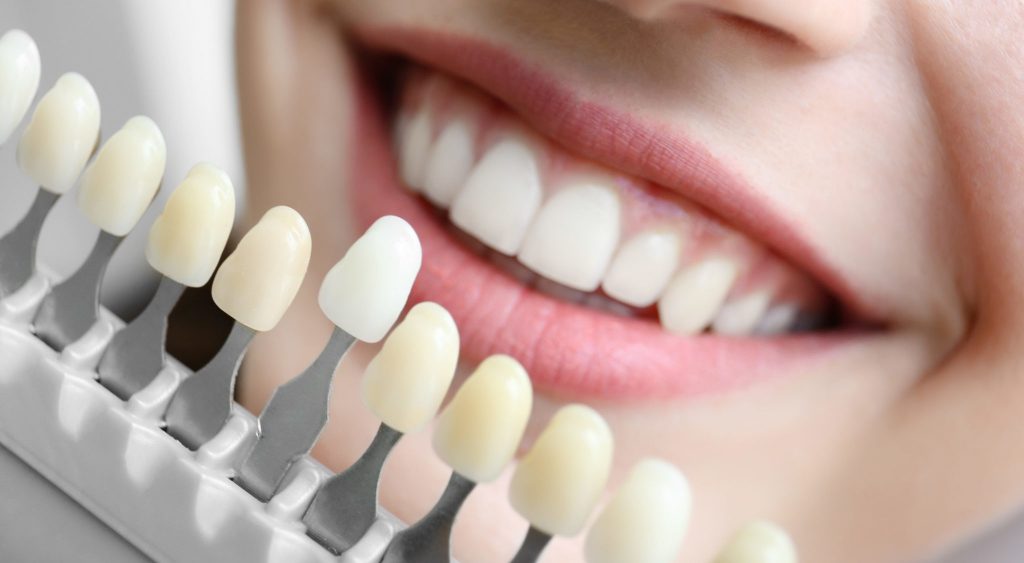 Выбор стоматологической клиники для установки коронок Импресс