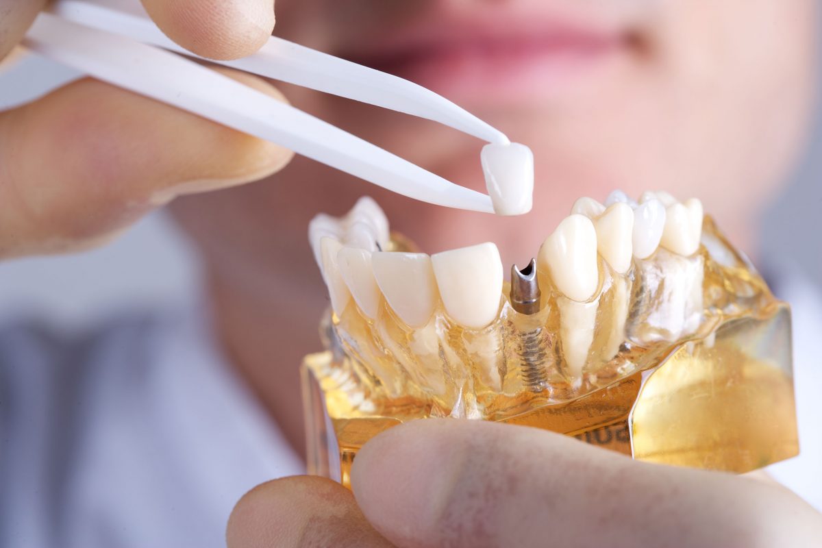 Стоимость корейских зубных имплантов.