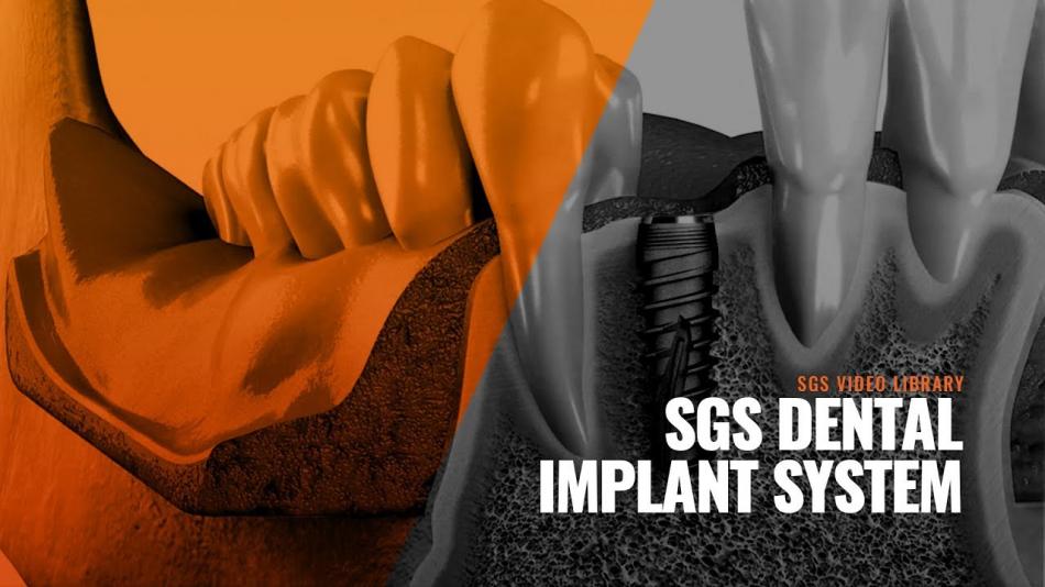 SGS импланты: виды систем