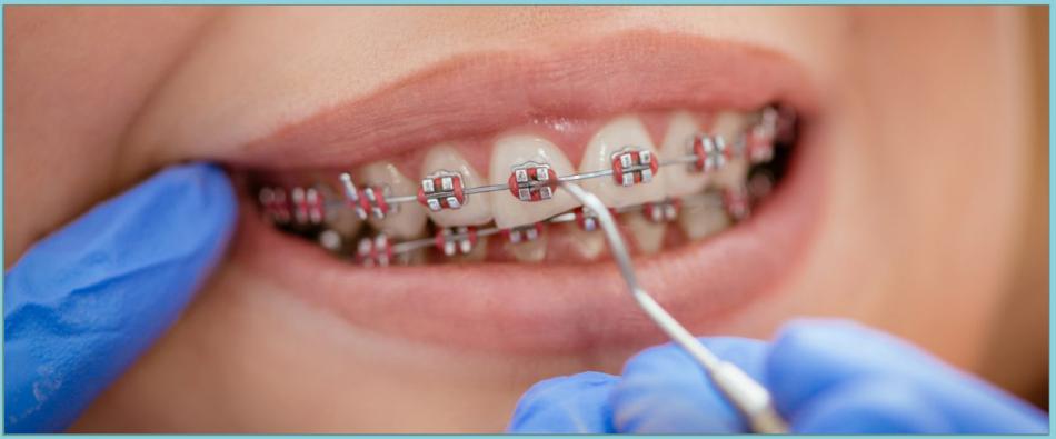 Как проходит снятие брекетов с зубов