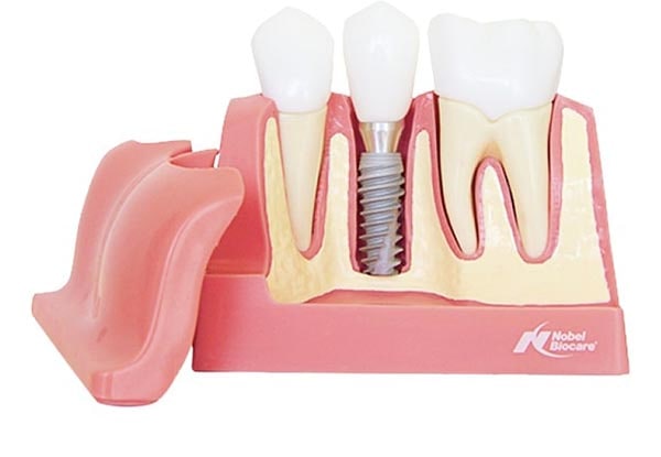Имплантация зубов Nobel Biocare Parallel CC под ключ - 49500 руб. (все этапы включены в стоимость)