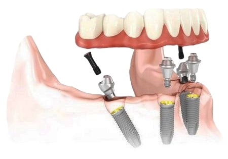 Протезирование зубов, запатентованное лидером мировой имплантологии компанией «NobelBioсare».