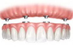 Технология воостановления всех зубов челюсти на имплантах - от 75.000р за одну челюсть