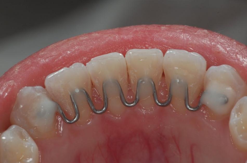 Как устанавливают несъемныы ретейнеры на зубы?