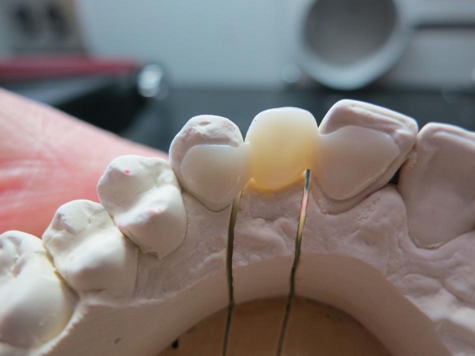 Адгезивный протез на зубы в стоматологии