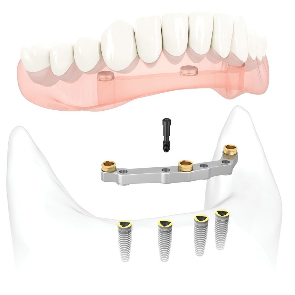 Как фиксируют зубные протезы на импланты?