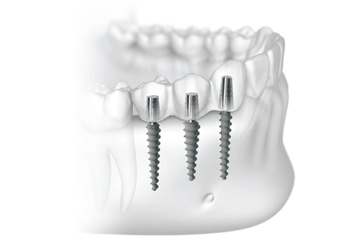 Сколько стоит базальная имплантация зубов?
