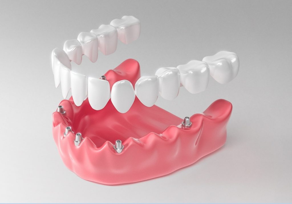 Имплантация зубов все на 6 имплантах: как устанавливают систему?