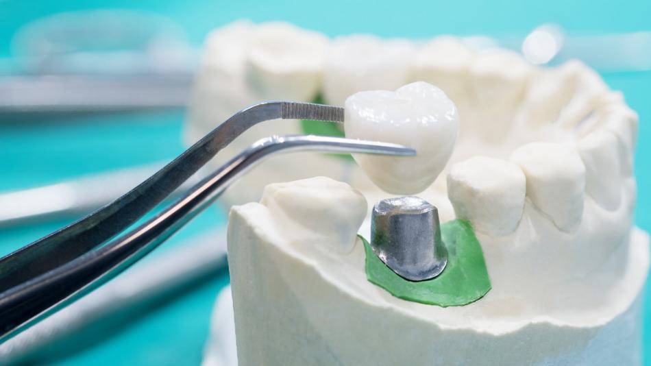 Одномоментная имплантация зубов с немедленной нагрузкой.