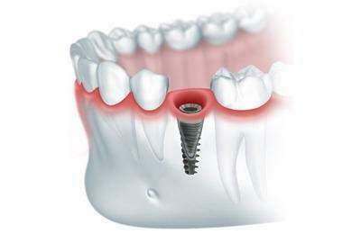 Как проходит немедленная имплантация зубов?
