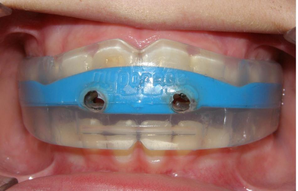Как устанавливают капы Myobrace в стоматологии.