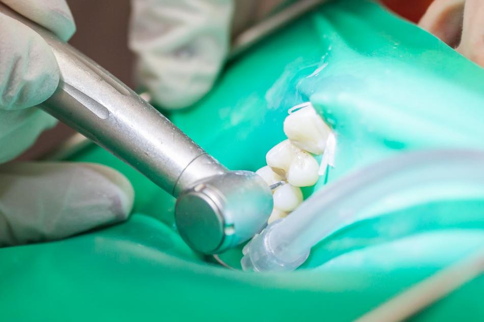 Сколько стоит лечение кариеса зубов?