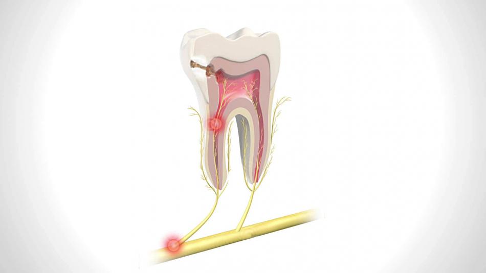 Лечение пульпита: стоматологические методы.