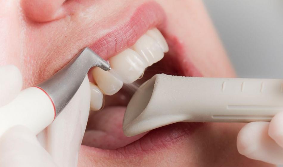 Как чистят зубы от налета методом Air Flow?