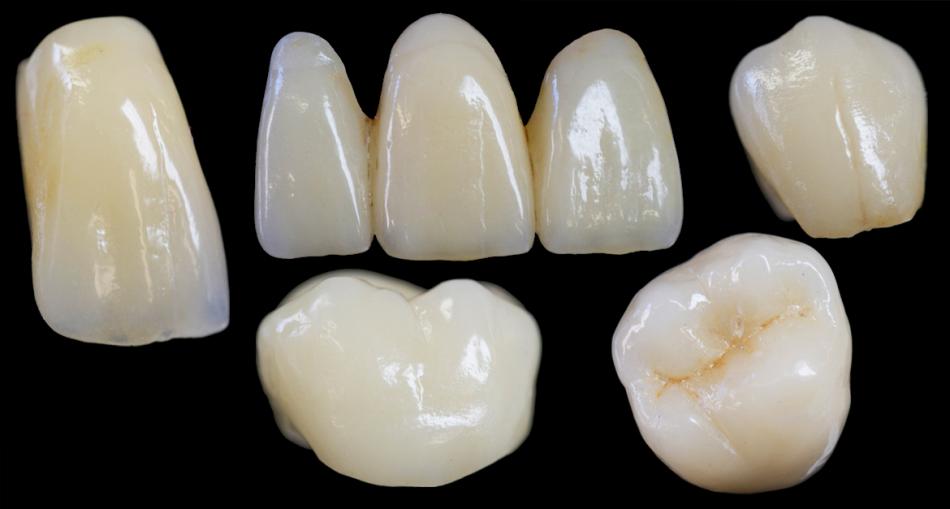 Сколько стоит микропротезирование зубной эмали?
