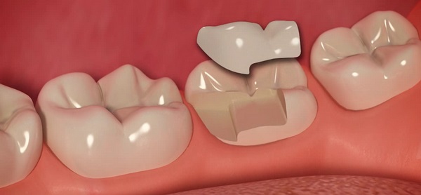 Когда делают микропротезирование зубной эмали?
