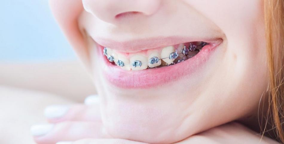Какие виды брекет-систем устанавливают на зубы?