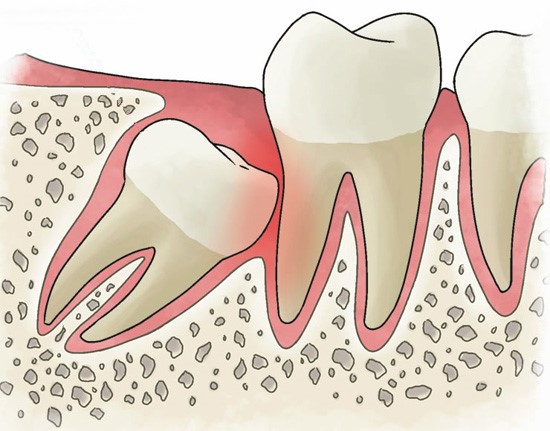 Как удаляют непрорезавшийся зуб?