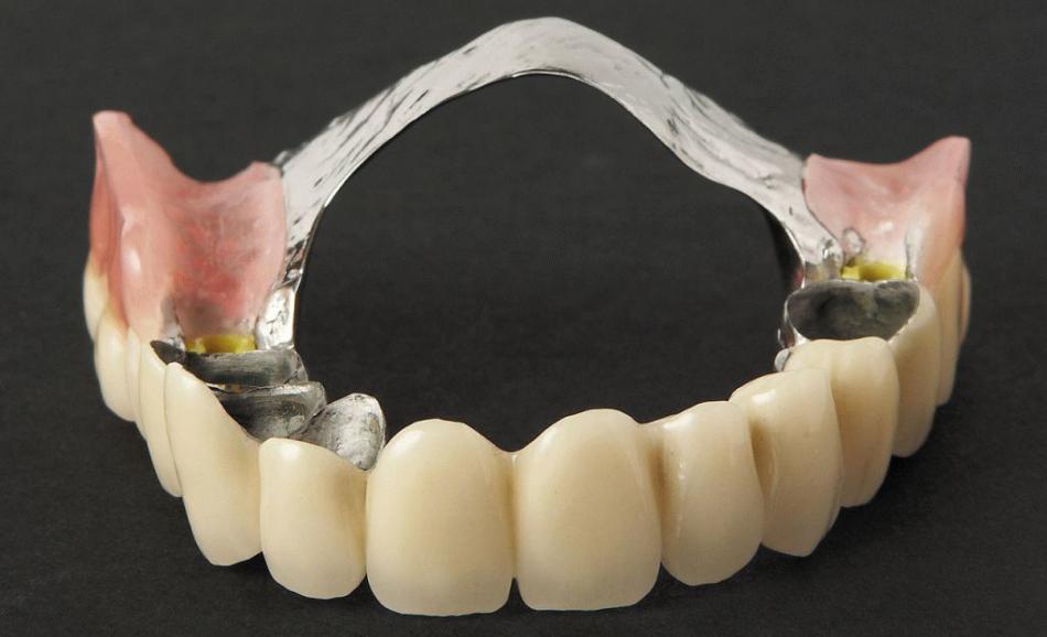 Цена на протезирование съемными зубными протезами.
