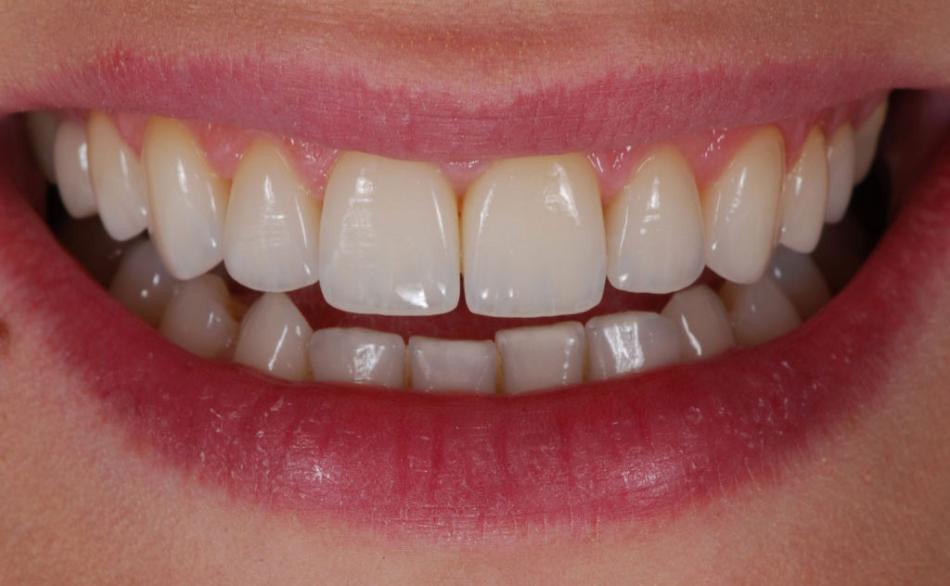 Преимущества зубных коронок из диоксида циркония.