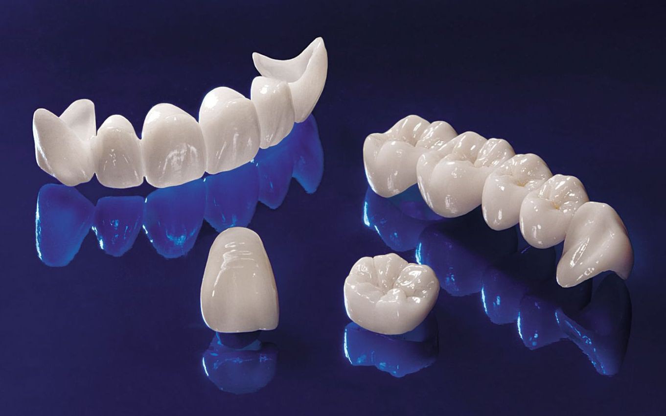 Безметалловые коронки на зубы: преимущества протезирования.