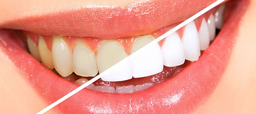 Стоимость отбеливания зубов в стоматологии.