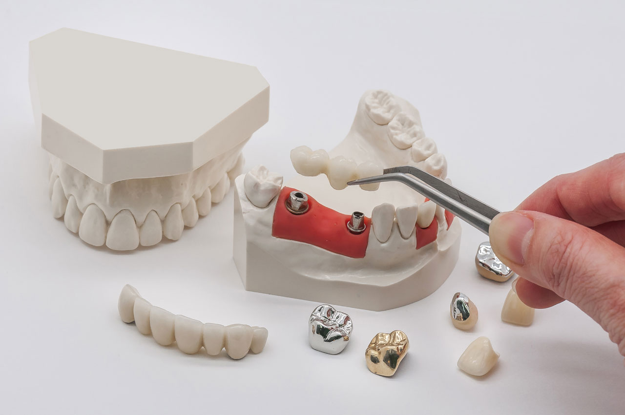 Импланты зубов: установка и виды систем