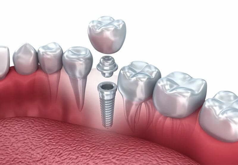 Что входит в имплантацию зубов под ключ?