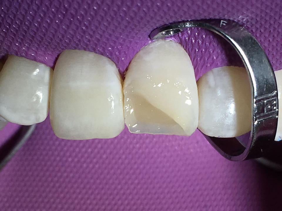 Из чего складывается цена на восстановление зубов?