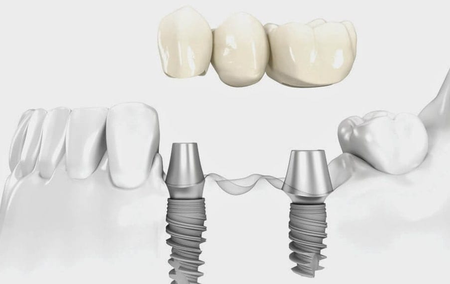Виды зубных мостов для протезирования.