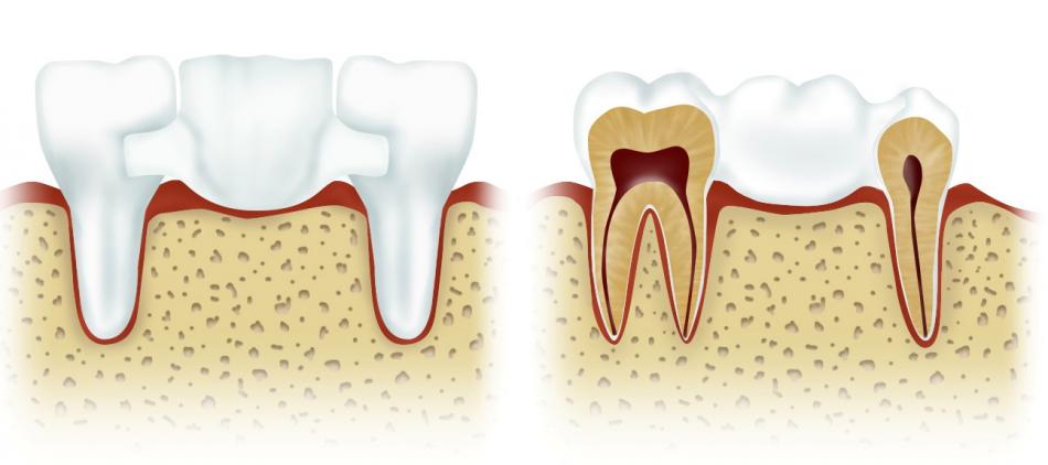 Мостовидный зубной протез: показания к установке.