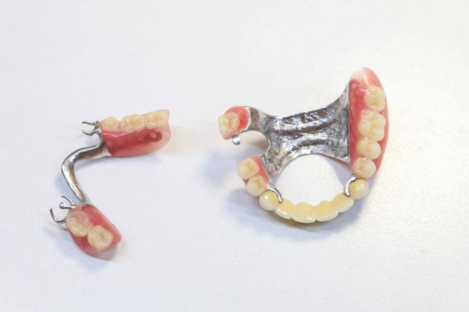 Как ставят бюгельный протез на зубы?