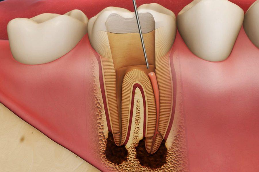 Воспаление зуба: симптомы и причины возникновения.