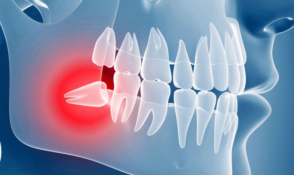 Профилактика воспалений зуба: рекомендации стоматолога.