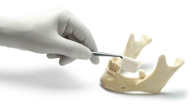 Сколько стоит остеопластика челюсти?