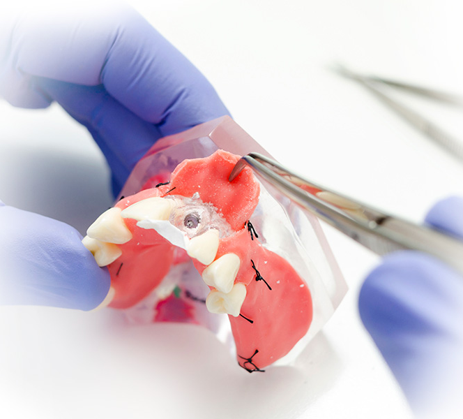 Костная пластика: наращивание костной ткани переж имплантацией на верхней или нижней челюсти.