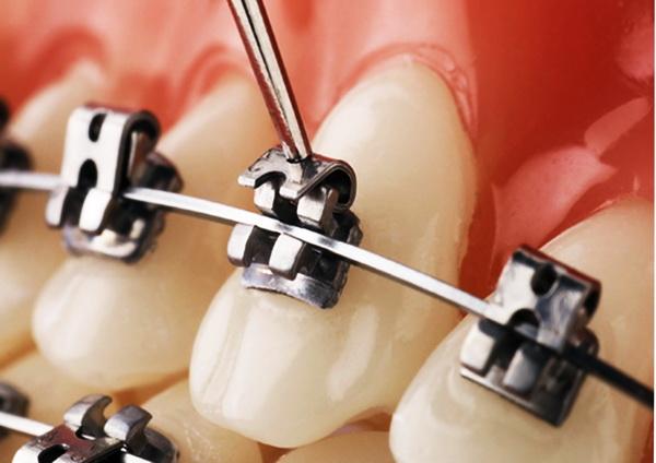 Как брекеты выравнивают зубы?