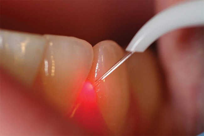 Цена лазерного удаления кисты под зубом в стоматологии.