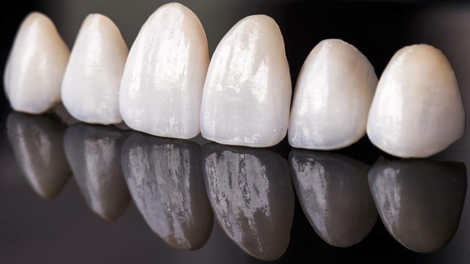 Виниры на зубы: виды микропротезов