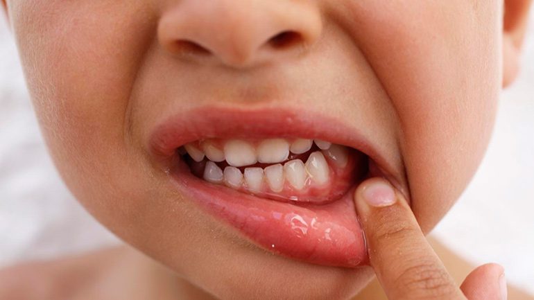 Периодонтит несформированного и постоянного зуба.