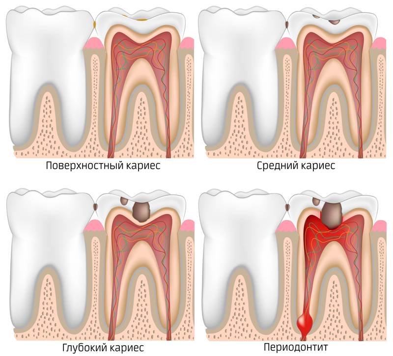 Как развивается периодонтит у детей на молочных и постоянных зубах.
