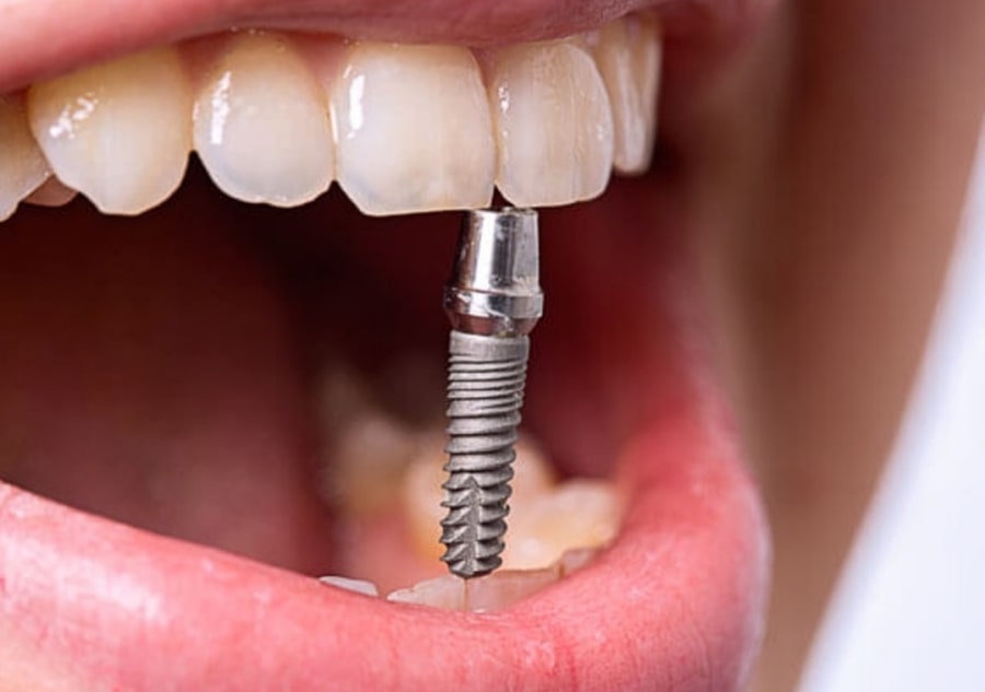 Марки и производители имплантов для зубов