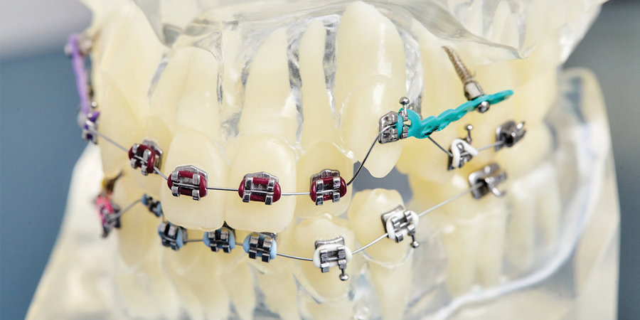 Стоимость установки зубного мини-импланта в стоматологии.